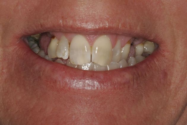 Dental Implants Upper and Lower Implants with Full Mouth Rehabilitation - Before