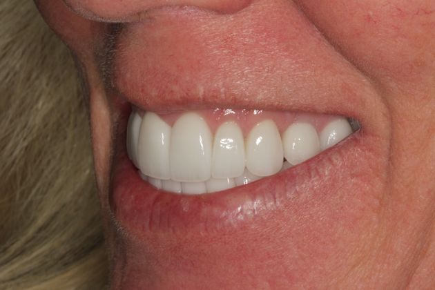 Dental Implants: Upper and Lower Implants with Full Mouth Rehabilitation - After