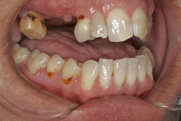 Dental Implants: Upper and Lower Implants with Full Mouth Rehabilitation - Before Restorative (after gum treatment & implant placement)