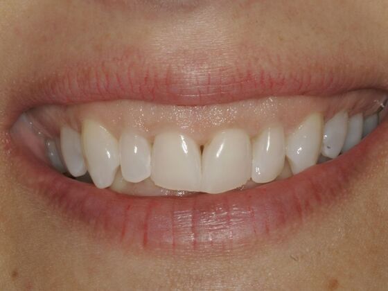 Full Mouth Rehabilitation Case 1 - Before
