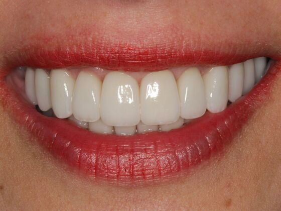 Full Mouth Rehabilitation Case 1 - After