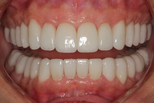 Full Mouth Rehabilitation: Full Mouth Rehabilitation - After