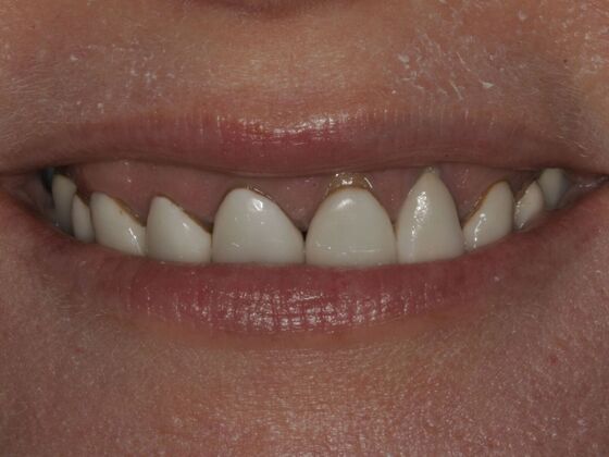 Full Mouth Rehabilitation Case 2 - Before