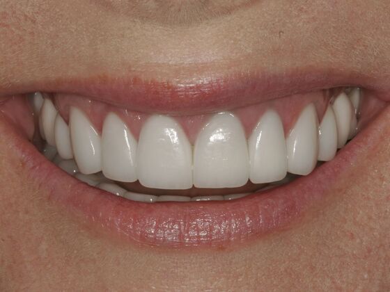 Full Mouth Rehabilitation Case 2 - After