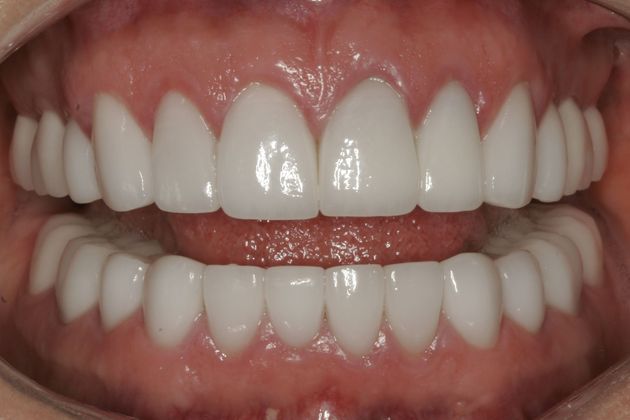 Full Mouth Rehabilitation: Full Mouth Reconstruction - After