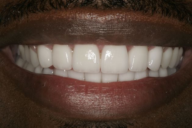 Dental Implants Implants with Full Mouth Reconstruction - After