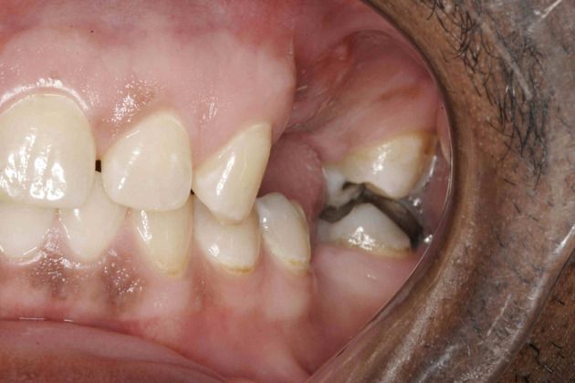 Dental Implants: Implants with Full Mouth Reconstruction - Before