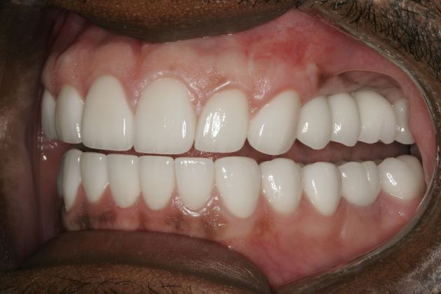 Dental Implants: Implants with Full Mouth Reconstruction - After