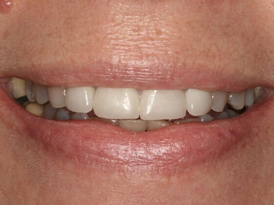 Smile Makeover Case 10 - Before