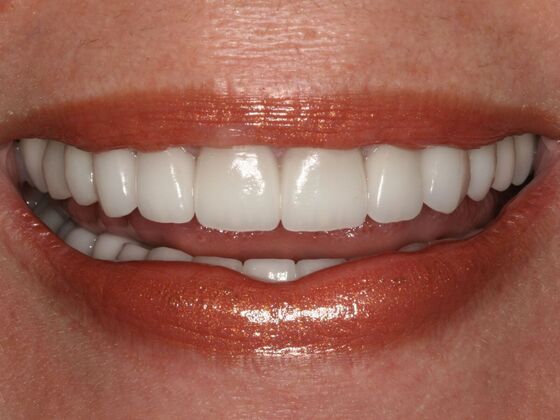 Smile Makeover Case 10 - After