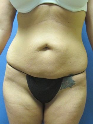 Abdominoplasty - Tummy Tuck Case 9 - Before