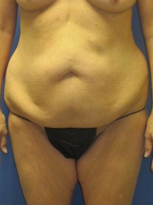 Abdominoplasty - Tummy Tuck Case 11 - Before