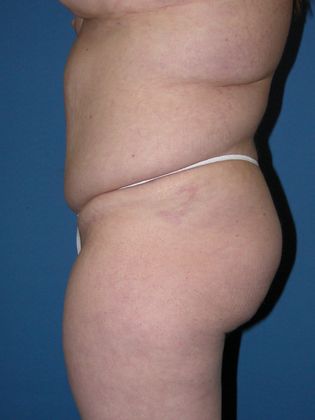 Abdominoplasty - Tummy Tuck: Case 14 - After