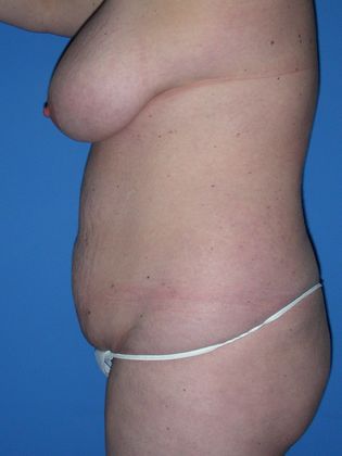 Abdominoplasty - Tummy Tuck: Case 18 - Before