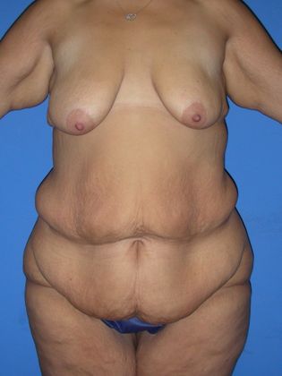 Abdominoplasty - Tummy Tuck Case 19 - Before