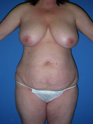 Mommy Makeover Case 7 - Before
