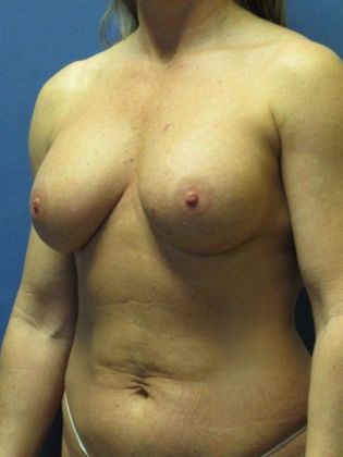 Breast Augmentation: Case 42 - After