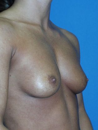 Breast Augmentation: Case 45 - Before