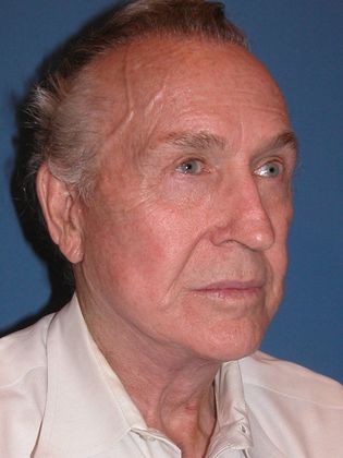 Facelift / RestoreLift: Case 16 - After