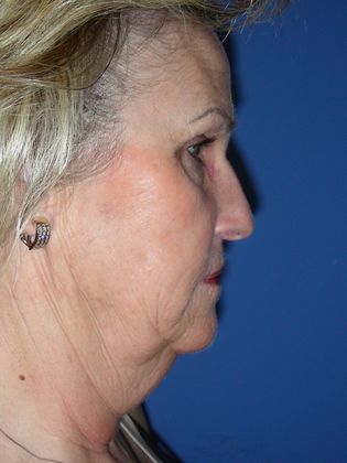 Facelift / RestoreLift Case 15 - Before