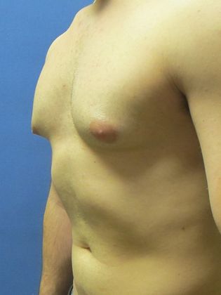 Gynecomastia Surgery (Male Breast Reduction Surgery) Case 9 - Before