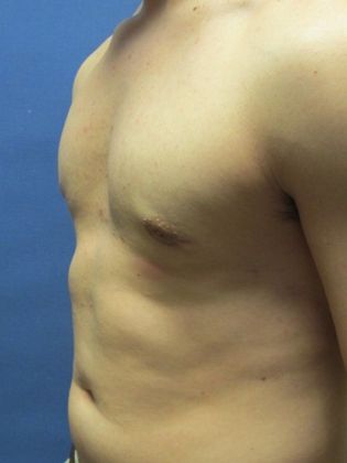 Gynecomastia Surgery (Male Breast Reduction Surgery) Case 9 - After