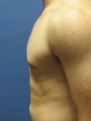 Gynecomastia Surgery (Male Breast Reduction Surgery): Case 9 - After