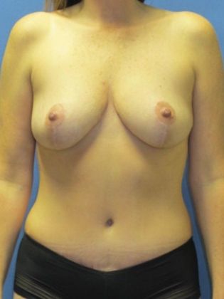 Breast Reduction/ Breast Lift Case 3 - After