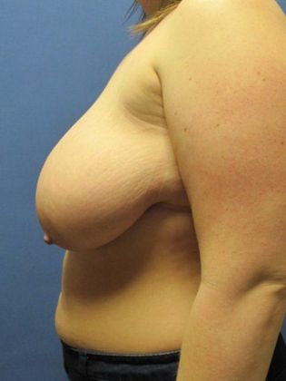 Breast Reduction/ Breast Lift: Case 6 - Before