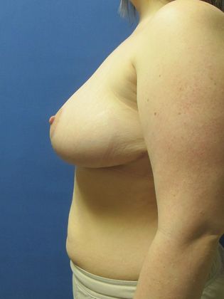 Breast Reduction/ Breast Lift: Case 6 - After