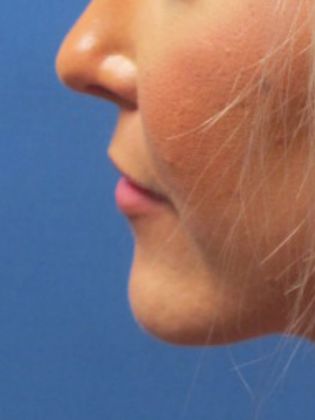 Lip Augmentation: Case 2 - Before