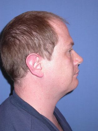 Chin Augmentation Case 4 - After