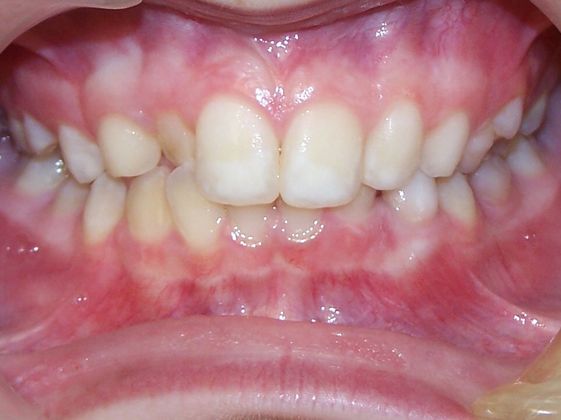 Narrow Arch - Narrow Smile: Narrow Arch with Anterior Cross Bite - Before