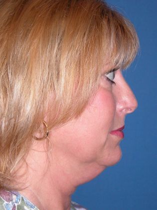 Facelift / RestoreLift Case 18 - Before