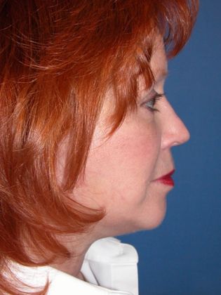 Chin Augmentation Case 5 - After