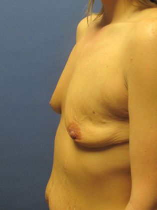 Breast Augmentation: Case 23 - Before