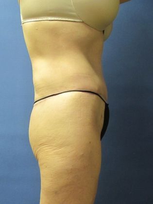 Post Bariatric Plastic Surgery/Body Lift: Case 1 - After