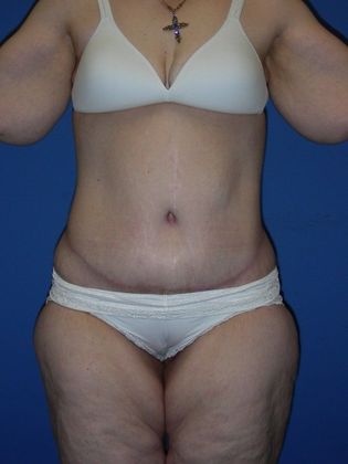 Post Bariatric Plastic Surgery/Body Lift Case 2 - After
