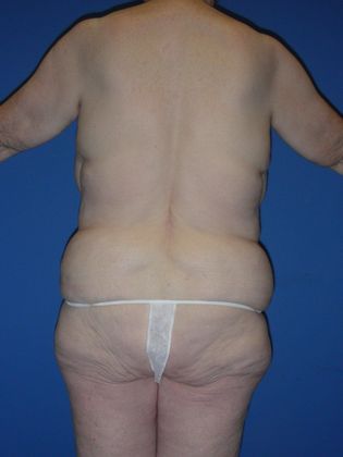 Post Bariatric Plastic Surgery Body Lift