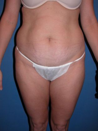 Liposuction Case 5 - Before