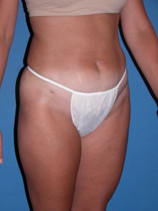 Liposuction: Case 5 - After