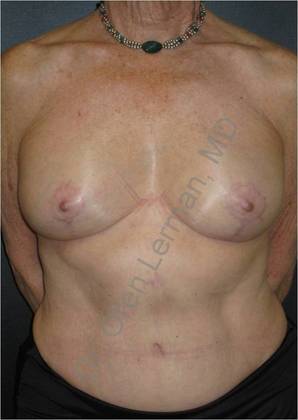 DIEP Flap Breast Reconstruction Surgery NJ