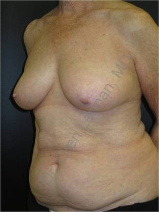 Case 5 - Upper East Side Manhattan, NY - DIEP Flap (natural tissue) Breast  Reconstruction - Before and After Gallery