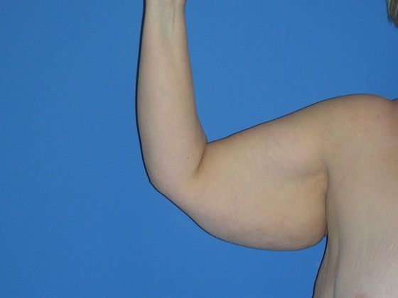 Arm Lift Case 1 - Before