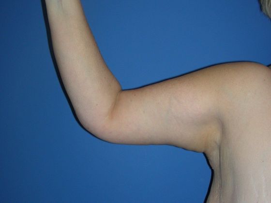 Arm Lift Case 1 - After