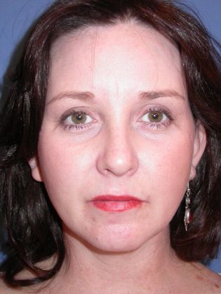 Brow Lift Case 4 - After