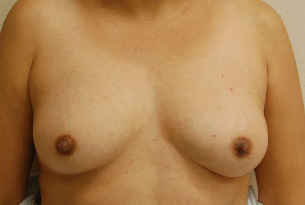 Breast Reconstruction Case 41 - Before