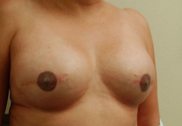 Breast Reconstruction: Case 41 - After