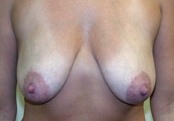 Breast Augmentation w/ Lift: Case 97 - Before