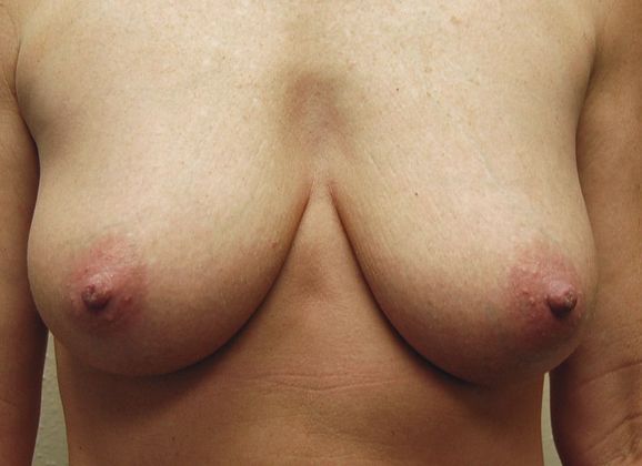 Breast Augmentation w/ Lift Case 98 - Before